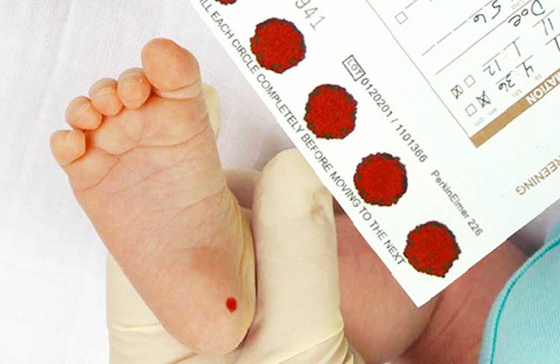 Chẩn đoán suy giáp qua sàng lọc sơ sinh bằng lấy máu gót chân ở trẻ